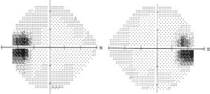 blind spot test normal results|How to interpret visual fields: 5 most common patterns.